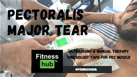 testing for pectoral major muscle tear|pectoralis tear treatment guidelines.